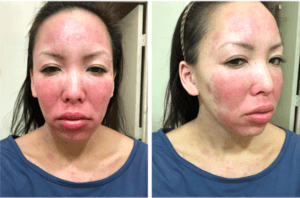 Hautreizung nach Gebrauch von unverdünnten ätherischen Ölen Weihrauchöl